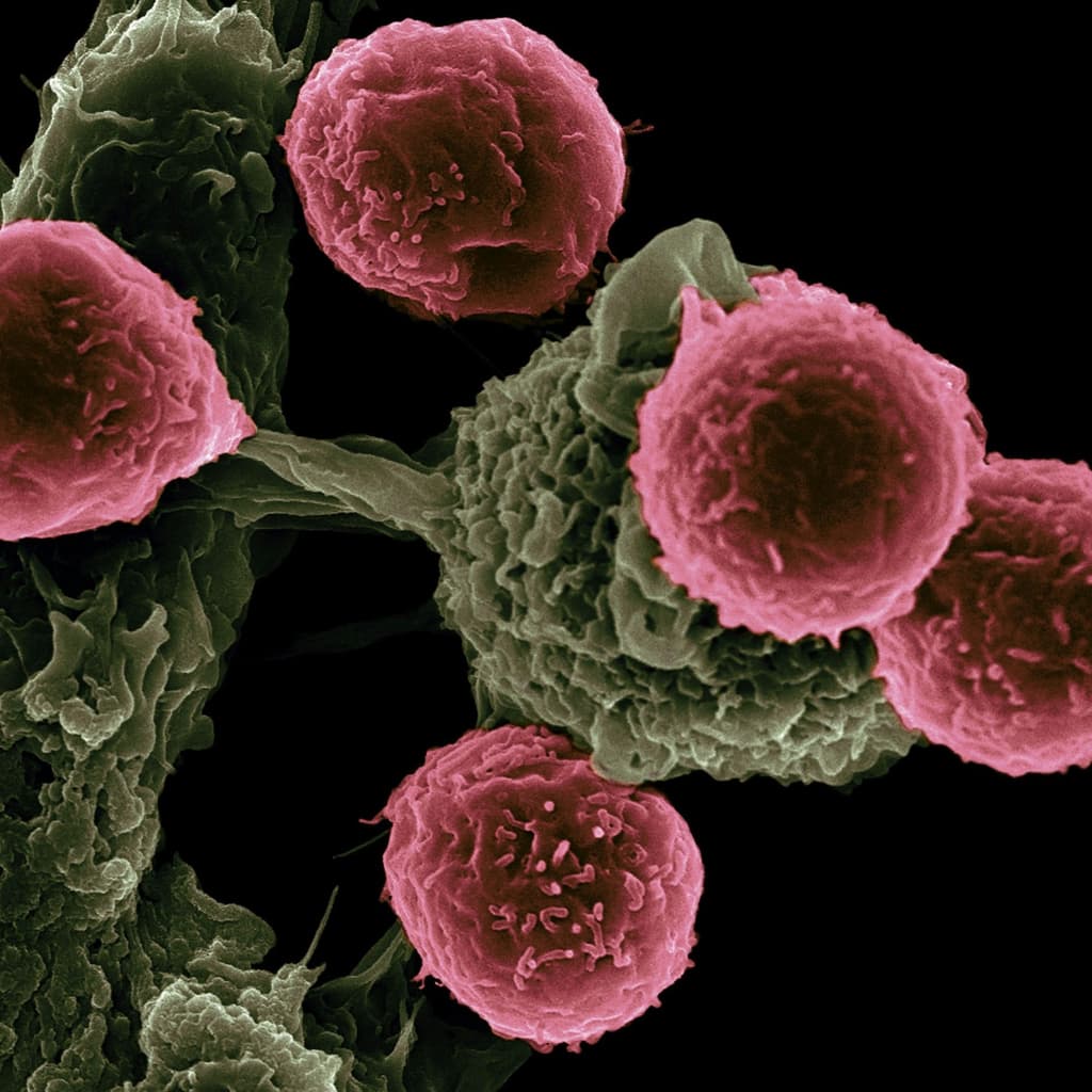Scanning electron micrograph of cancer cells