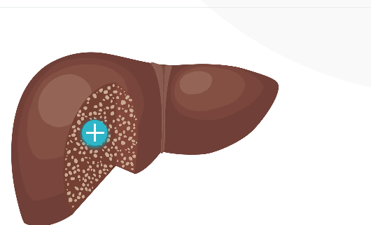 Illustration of a liver with cirrhosis